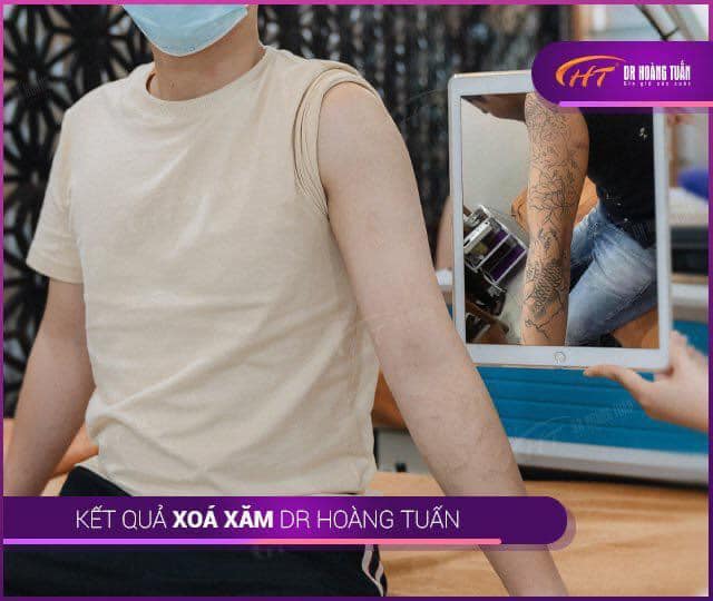 Xoá xăm bằng laser bao nhiêu tiền?